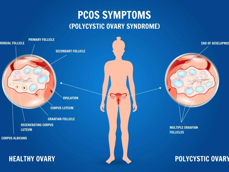 PCOS Symptoms, Diagnosis, and Treatment Options
