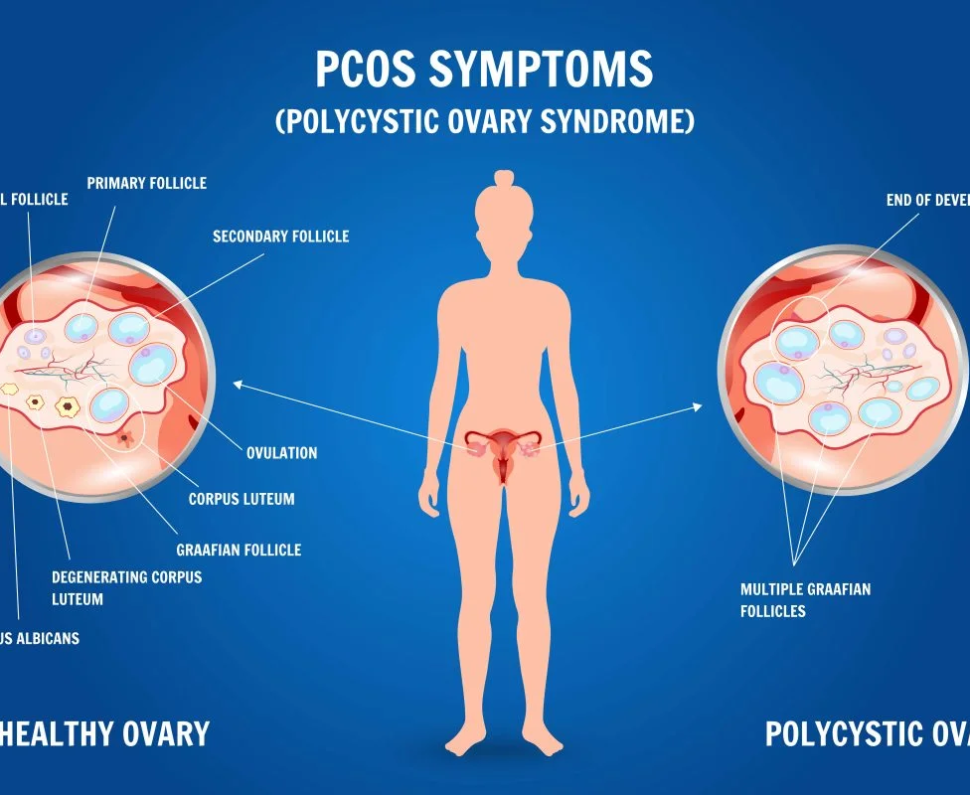 PCOS Symptoms, Diagnosis, and Treatment Options
