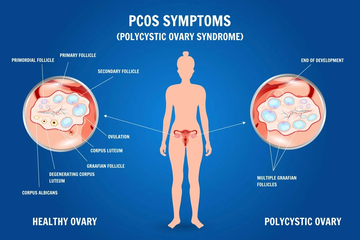 No Pcos PCOS Symptoms Diagnosis and Treatment Options : Dr Nitasha