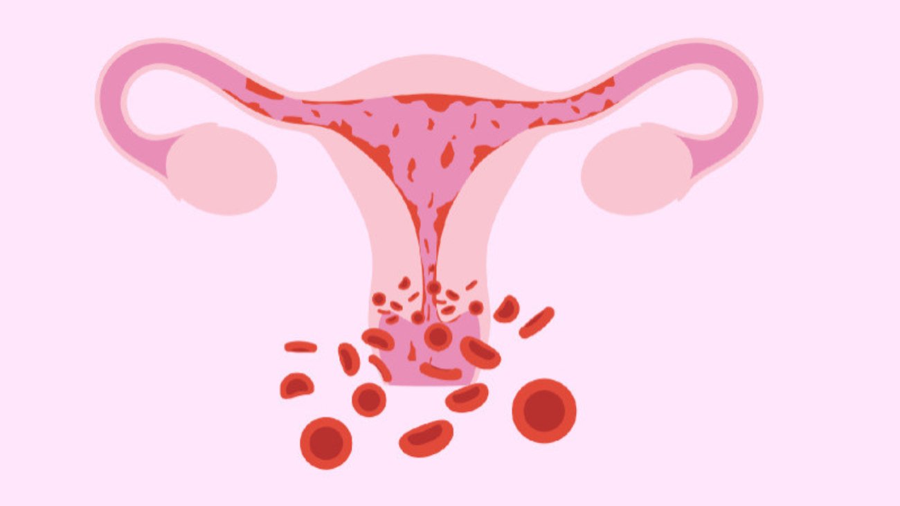 Heavy Periods (Menorrhagia): Causes & Treatment