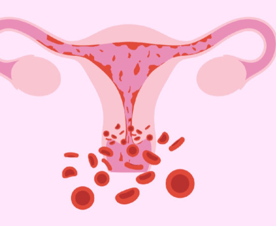 Heavy Periods (Menorrhagia): Causes & Treatment