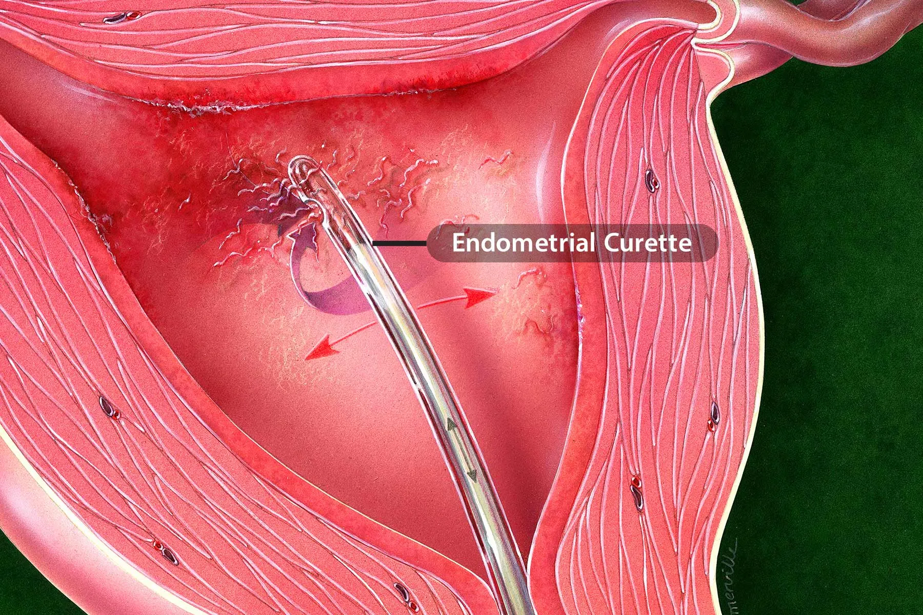 Endometrial Biopsy
