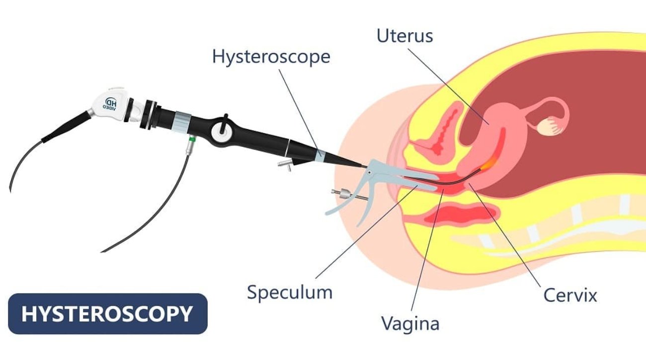Hysteroscopy Polypectomy for Infertility | Dr. Nitasha Gupta