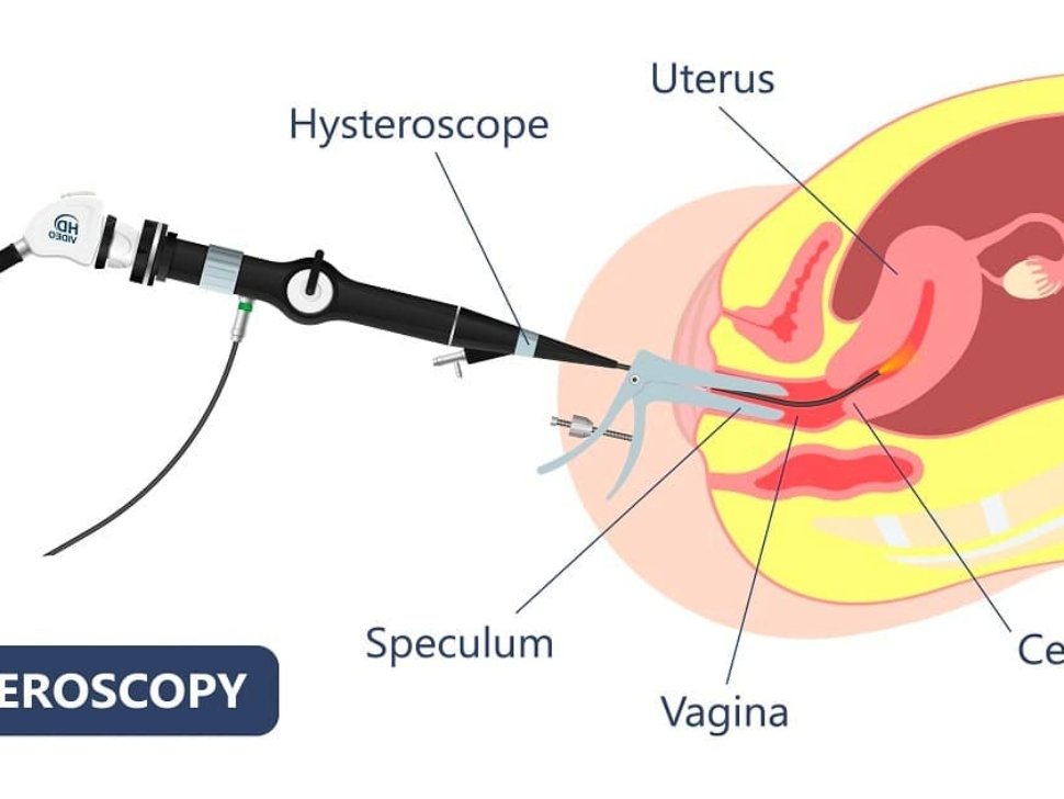 Hysteroscopy Polypectomy for Infertility | Dr. Nitasha Gupta