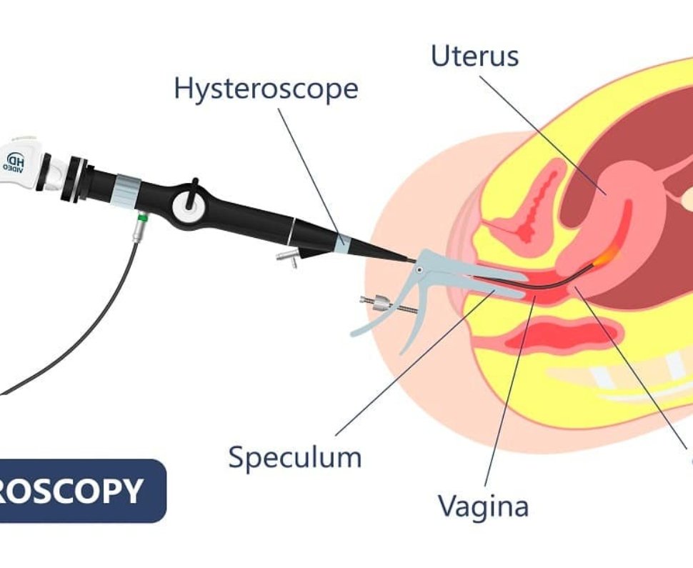 Hysteroscopy Polypectomy for Infertility | Dr. Nitasha Gupta