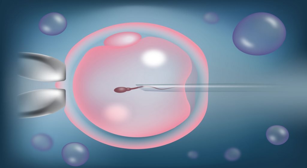 ICSI — Micromanipulation for male factor