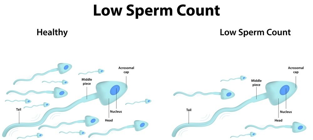 Low sperm count
