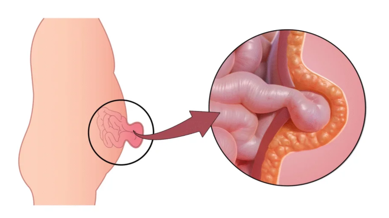 Umbilical Hernia: Symptoms, Causes, Treatment & Recovery Guide