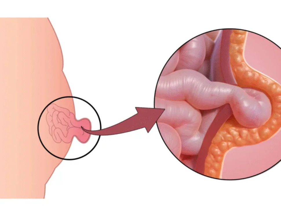 Umbilical Hernia: Symptoms, Causes, Treatment & Recovery Guide