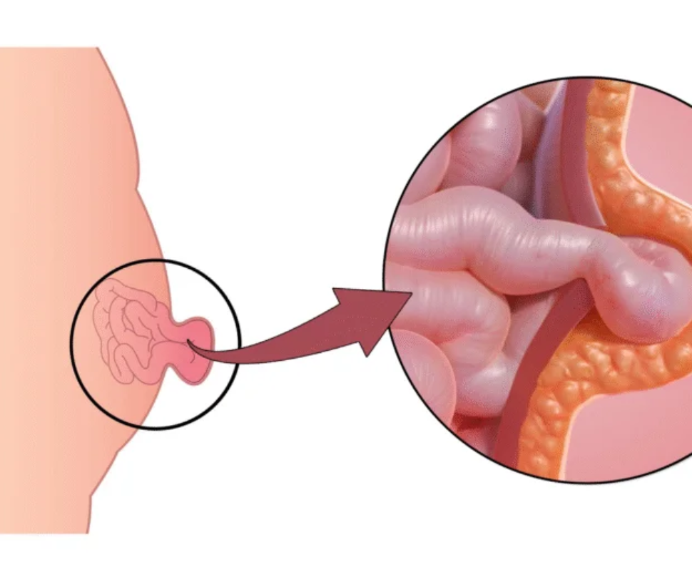 Umbilical Hernia: Symptoms, Causes, Treatment & Recovery Guide